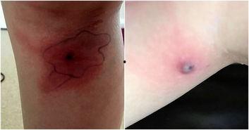 伤口流脓图片,伤口流脓症状解析与护理要点